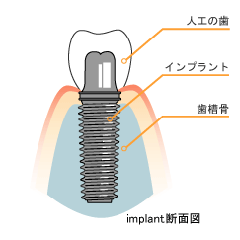 インプラント断面図